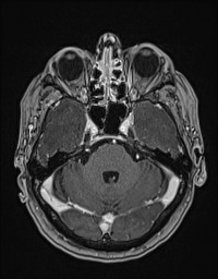Cerebral amyloid angiopathy-related inflammation (Radiopaedia 58270-65377 Axial T1 C+ fat sat 35).jpg