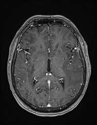 Cerebral amyloid angiopathy-related inflammation (Radiopaedia 58270-65377 Axial T1 C+ fat sat 70).jpg