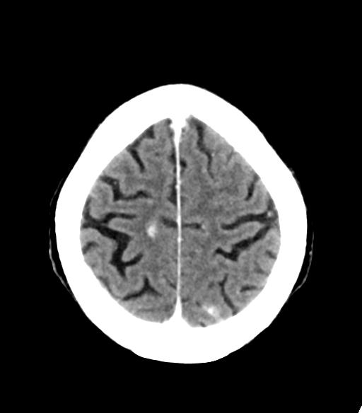 File:Cerebral aneurysm with rupture (Radiopaedia 29933-30460 Axial non-contrast 23).jpg