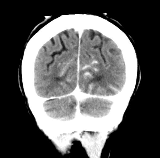 File:Cerebral aneurysm with rupture (Radiopaedia 29933-30460 Coronal non-contrast 31).jpg