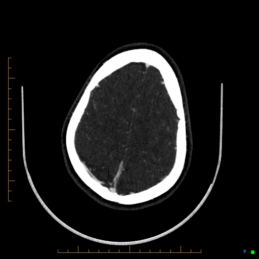 Cerebral arteriovenous malformation (AVM) (Radiopaedia 78162-90706 Axial CTA 222).jpg