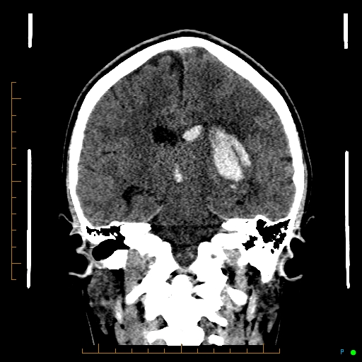 File:Cerebral arteriovenous malformation (AVM) (Radiopaedia 78162-90706 Coronal non-contrast 56).jpg