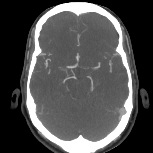 Cerebral arteriovenous malformation (Radiopaedia 39259-41505 AX CEREBRAL CTA 22).png