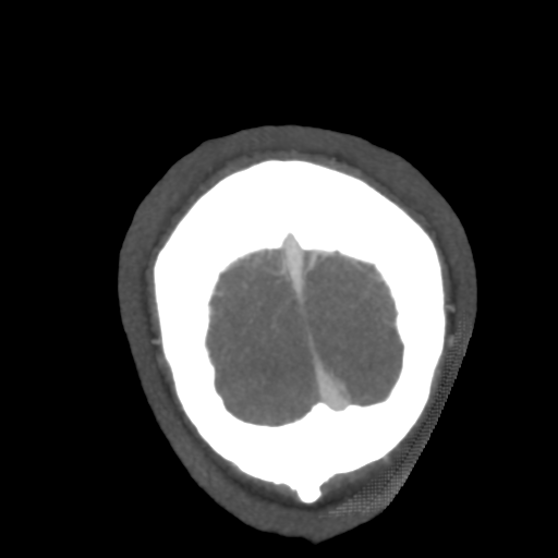 Cerebral arteriovenous malformation (Radiopaedia 39259-41505 E 68).png
