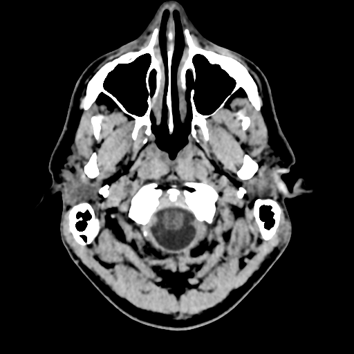 File:Cerebral arteriovenous malformation (Radiopaedia 55798-62371 Axial non-contrast 6).png