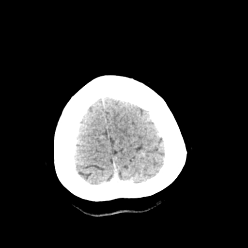 File:Cerebral arteriovenous malformation (Radiopaedia 73830-84645 Axial non-contrast 42).jpg