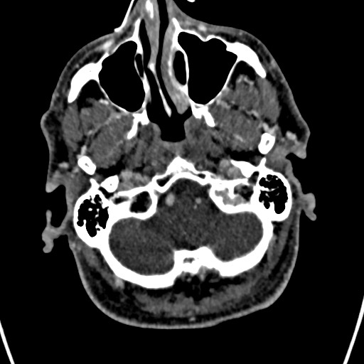 Cerebral arteriovenous malformation (Radiopaedia 78188-90746 Axial C+ delayed 21).jpg