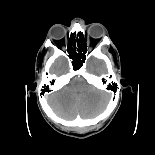 Cerebral arteriovenous malformation (Spetzler-Martin grade 2) (Radiopaedia 41262-44076 Axial C+ 12).png
