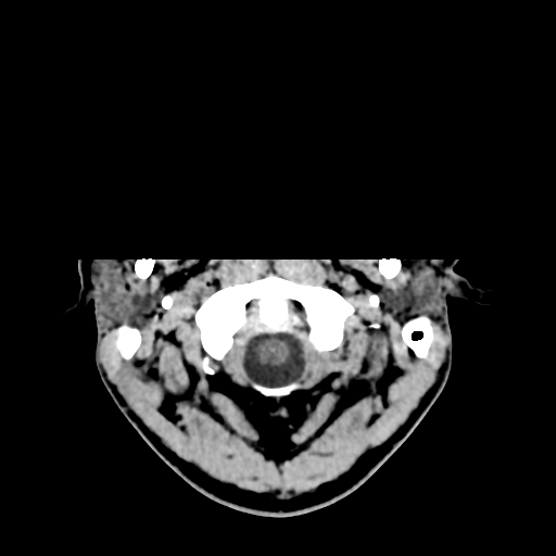 Cerebral arteriovenous malformation (Spetzler-Martin grade 2) (Radiopaedia 41262-44076 Axial non-contrast 4).png