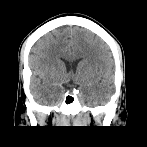 File:Cerebral arteriovenous malformation (Spetzler-Martin grade 2) (Radiopaedia 41262-44076 Coronal non-contrast 26).png