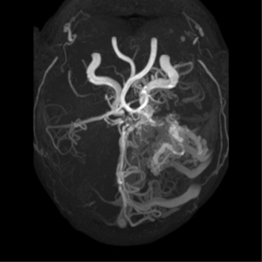File:Cerebral arteriovenous malformation - huge (Radiopaedia 35734-37272 MRA 12).png