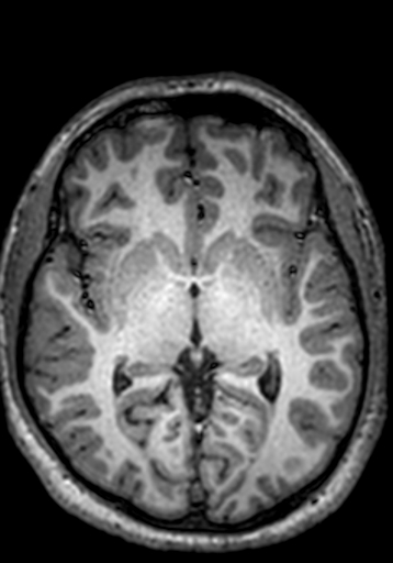 Cerebral arteriovenous malformation at posterior body of corpus callosum (Radiopaedia 74111-84925 Axial T1 156).jpg