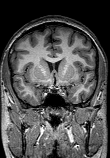 Cerebral arteriovenous malformation at posterior body of corpus callosum (Radiopaedia 74111-84925 Coronal T1 119).jpg
