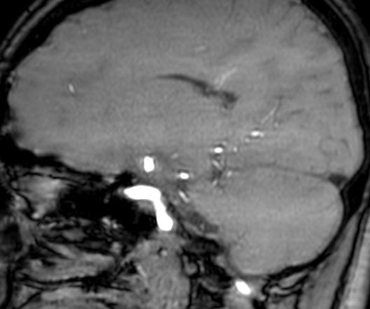 Cerebral arteriovenous malformation at posterior body of corpus callosum (Radiopaedia 74111-84925 J 151).jpg