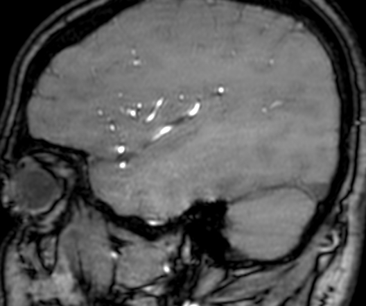 File:Cerebral arteriovenous malformation at posterior body of corpus callosum (Radiopaedia 74111-84925 J 314).jpg