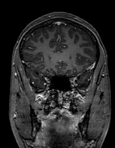 Cerebral arteriovenous malformation at posterior body of corpus callosum (Radiopaedia 74111-84925 K 103).jpg