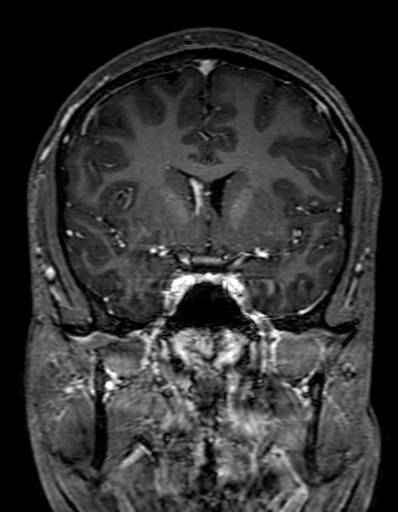 Cerebral arteriovenous malformation at posterior body of corpus callosum (Radiopaedia 74111-84925 K 145).jpg