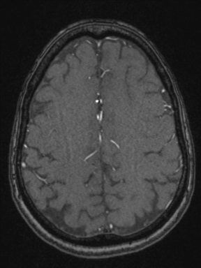 Cerebral arteriovenous malformation with hemorrhage (Radiopaedia 34422-35737 Axial MRA 63).png