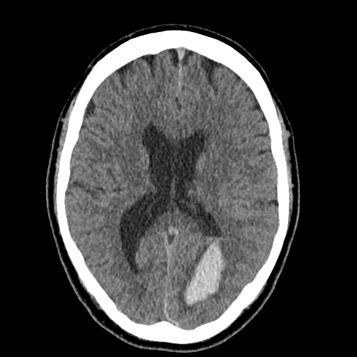 Cerebral arteriovenous malformation with lobar hemorrhage (Radiopaedia 35598-37117 Axial non-contrast 31).jpg