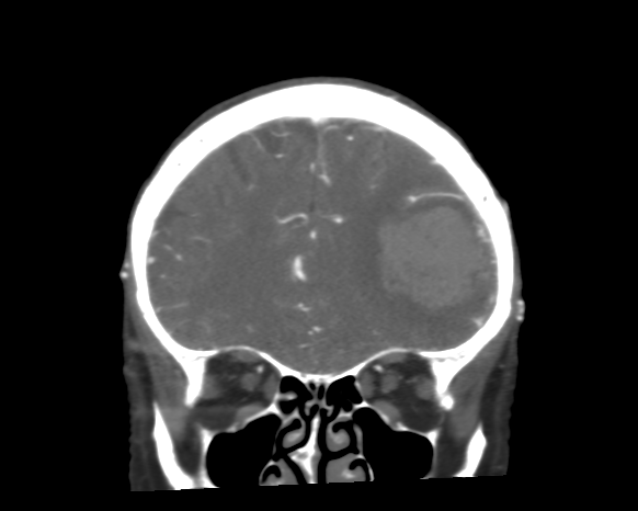 Cerebral arteriovenous malformation with lobar hemorrhage (Radiopaedia 44725-48511 A 16).png