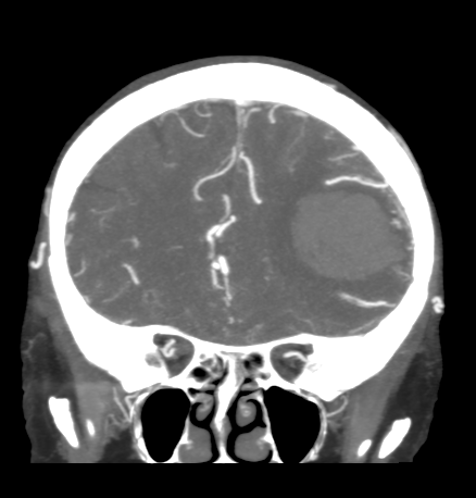 Cerebral arteriovenous malformation with lobar hemorrhage (Radiopaedia 44725-48511 B 18).png