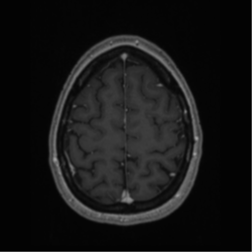 Cerebral cavernoma and development venous anomaly (Radiopaedia 37603-39482 Axial T1 C+ 62).png