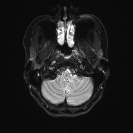 File:Cerebral cavernous venous malformation (Radiopaedia 70008-80021 Axial DWI 4).jpg