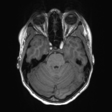 Cerebral cavernous venous malformation (Radiopaedia 70008-80021 Axial T1 21).jpg
