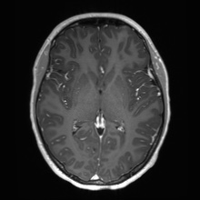 File:Cerebral cavernous venous malformation (Radiopaedia 70008-80021 Axial T1 C+ 36).jpg