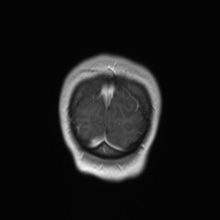 File:Cerebral cavernous venous malformation (Radiopaedia 70008-80021 Coronal T1 C+ 5).jpg