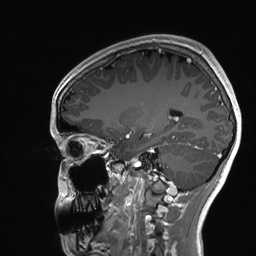 Cerebral cavernous venous malformation (Radiopaedia 70008-80021 Sagittal T1 C+ 25).jpg