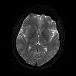 Cerebral cavernous venous malformation (Zabramski type II) (Radiopaedia 85511-101198 Axial DWI 83).jpg