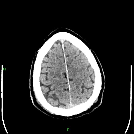 File:Cerebral contusions (Radiopaedia 33868-35039 Axial non-contrast 183).jpg