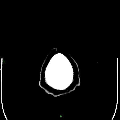 Cerebral contusions (Radiopaedia 33868-35039 Axial non-contrast 220).jpg