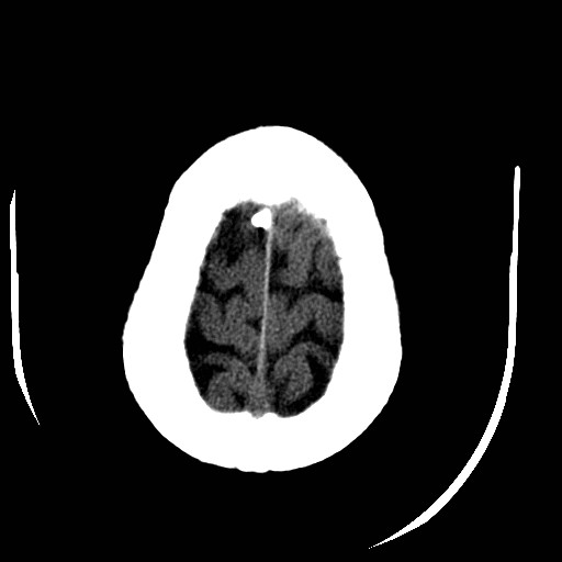 Cerebral edema (evolution in time) (Radiopaedia 19418-19440 non-contrast 84).jpg