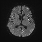 Cerebral embolic infarcts (embolic shower) (Radiopaedia 72391-82921 Axial DWI 46).jpg