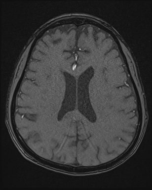 Cerebral embolic infarcts (embolic shower) (Radiopaedia 72391-82921 Axial MRA 124).jpg