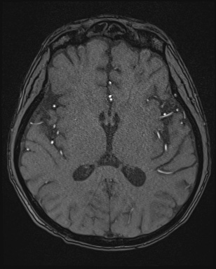 Cerebral embolic infarcts (embolic shower) (Radiopaedia 72391-82921 Axial MRA 98).jpg