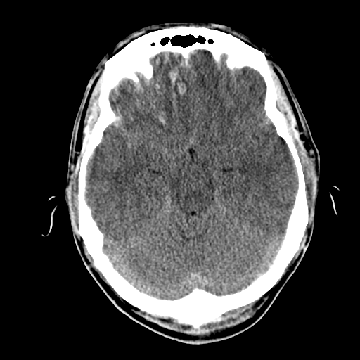 File:Cerebral hemorrhagic contusions- temporal evolution (Radiopaedia 40224-42753 Axial non-contrast 12).png