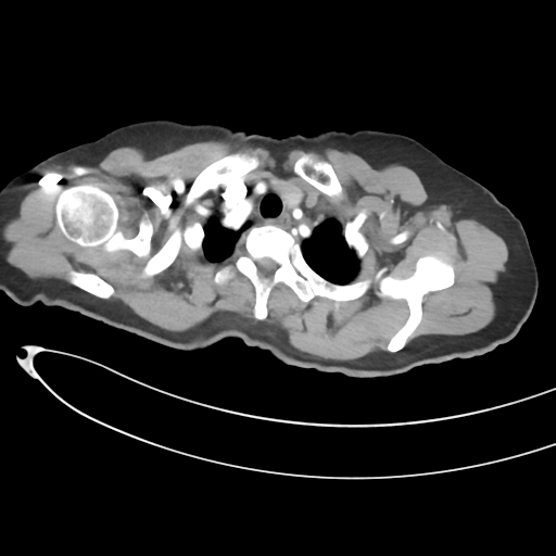 Cerebral metastases (Radiopaedia 33041-34055 A 8).png
