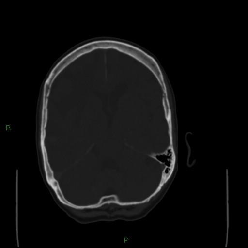 Cerebral metastases - breast primary (Radiopaedia 77653-89857 Axial bone window 50).jpg