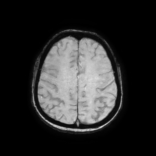 Cerebral metastases - melanoma (Radiopaedia 80972-94522 Axial SWI 71).jpg