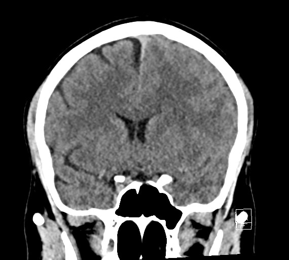Cerebral metastases - testicular choriocarcinoma (Radiopaedia 84486-99855 Coronal C+ delayed 26).jpg
