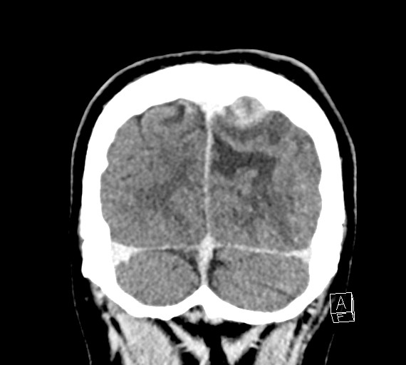 Cerebral metastases - testicular choriocarcinoma (Radiopaedia 84486-99855 D 54).jpg
