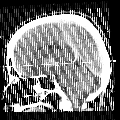 Cerebral metastasis to basal ganglia (Radiopaedia 81568-95412 Coronal C+ delayed 1).png