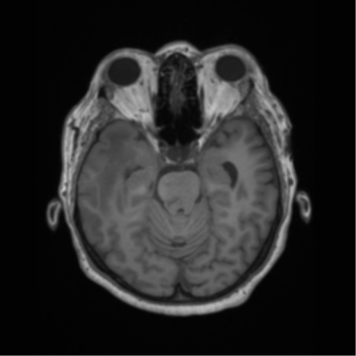 File:Cerebral metastasis to basal ganglia (Radiopaedia 81568-95413 Axial T1 24).png