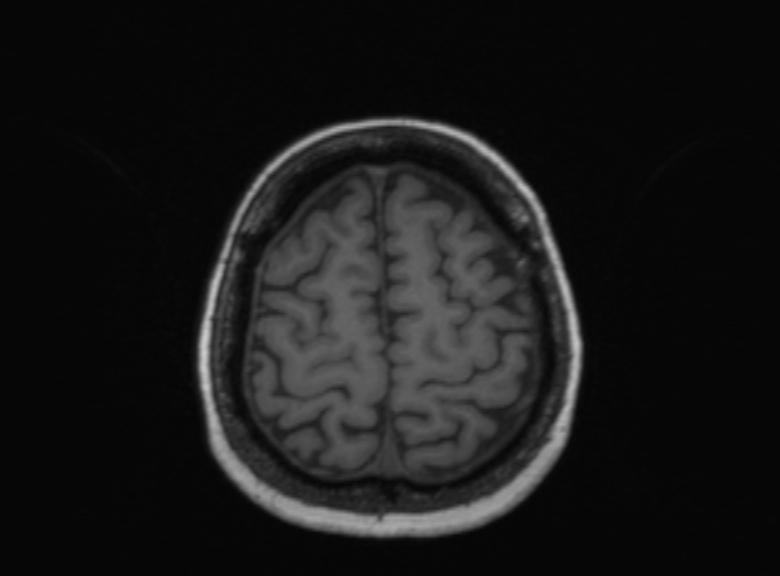 Cerebral ring enhancing lesions - cerebral metastases (Radiopaedia 44922-48817 Axial T1 135).jpg