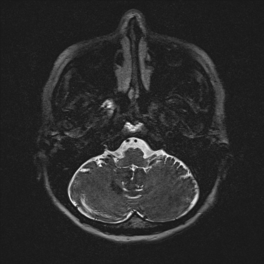 Cerebral ring enhancing lesions - cerebral metastases (Radiopaedia 44922-48817 F 14).jpg