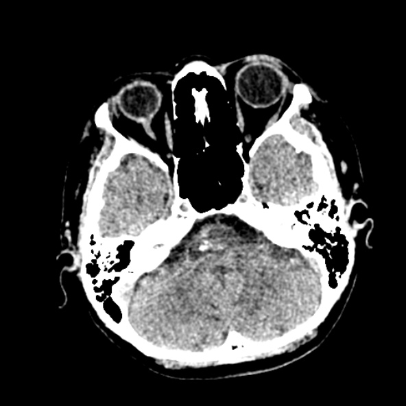 Cerebral ring enhancing lesions - cerebral metastases (Radiopaedia 44922-48818 Axial non-contrast 20).jpg
