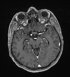 Cerebral toxoplasmosis (Radiopaedia 43956-47461 Axial T1 C+ 29).jpg